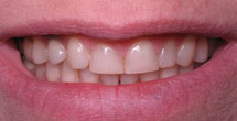 Dark colroed teeth with yellowing