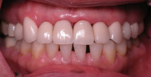 White healthy teeth and gums
