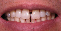 Patient with large gap between front teeth