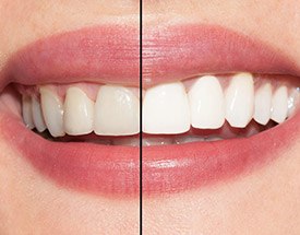 Smile half before and half after teeth whitening