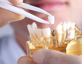 Cumming implant dentist holding restoration and model jaw