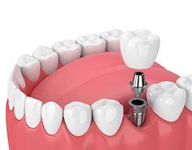 single dental implant supporting a crown