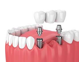 two dental implants supporting a dental bridge