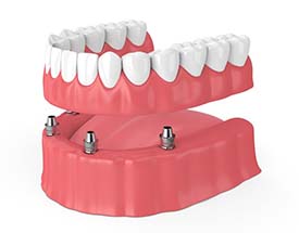 four dental implants supporting a full denture