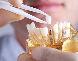 dentist placing a crown onto a dental implant in a model of the jaw