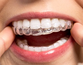 Closeup of patient placing Invisalign tray