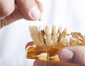 Model of implant retained dental crown