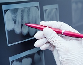 Hand pointing to dental x-rays