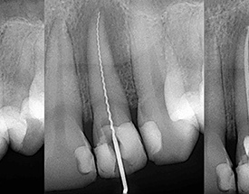 Digital x-rays of root canal process
