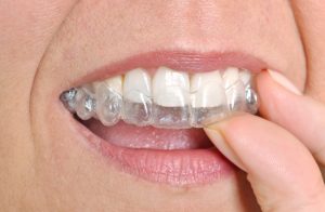 Invisalign clear braces Cumming Ga