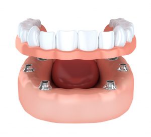 Your dentist in Cumming combines dental implants and dentures to restore lost teeth. 