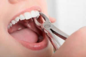 woman mouth open for tooth extraction