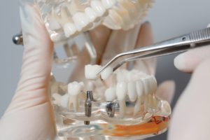 plastic model of dental implants replacing missing teeth